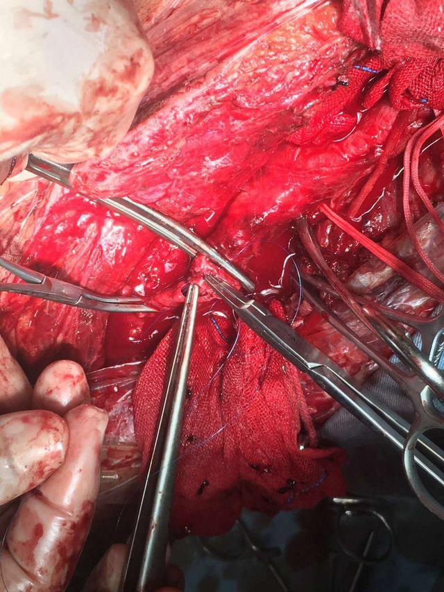 宰牛刀割断大腿动脉血管生命垂危 多学科联合手术患者