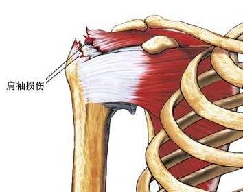健身弄伤肩膀,你连衣服都脱不了,还健身?