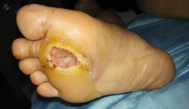 图二:赵女士受伤才半个月的右足(清创后) 赵女士入院后查空腹血糖19.