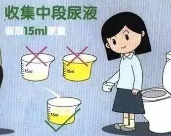 留取尿标本应注意:做尿常规留取标本时,需要保持外阴清洁并请留中段尿